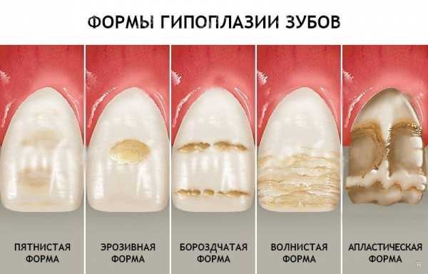 Какие факторы являются самыми опасными для эмали зубов