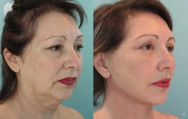 Какие процедуры для омоложения кожи лица после 50 лет самые эффективные