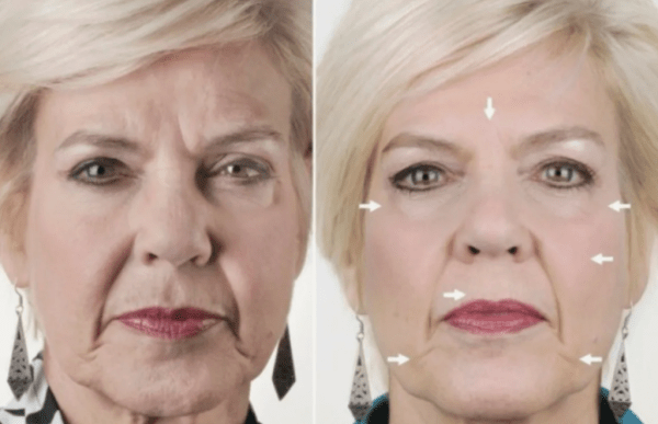 Идеальный лифтинг: как работает косметологическая процедура «фулфейс»